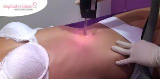 Depilación láser Alejandrita Laser Alejandrita