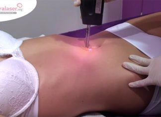 Depilación láser Alejandrita Laser Alejandrita